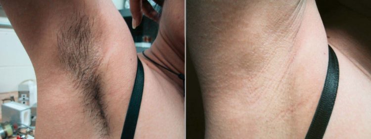 under-arm-hair-removal