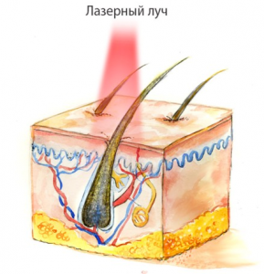 Лазерная эпиляция - принцип действия