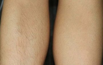 Лазерная эпиляция ног до и после