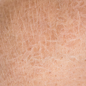 Сухость кожи после лазерной эпиляции