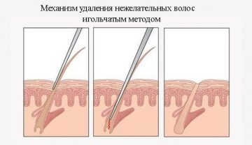 Что такое электро эпиляция навсегда. Смотреть фото Что такое электро эпиляция навсегда. Смотреть картинку Что такое электро эпиляция навсегда. Картинка про Что такое электро эпиляция навсегда. Фото Что такое электро эпиляция навсегда