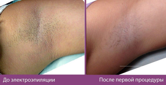 Чем опасна электроэпиляция подмышек. Смотреть фото Чем опасна электроэпиляция подмышек. Смотреть картинку Чем опасна электроэпиляция подмышек. Картинка про Чем опасна электроэпиляция подмышек. Фото Чем опасна электроэпиляция подмышек