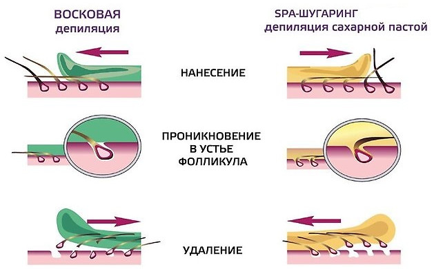 Техника проведения процедуры ваксинга и шугаринга