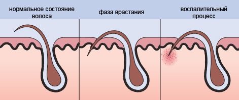 Как избавиться от волос на животе у девушек дома